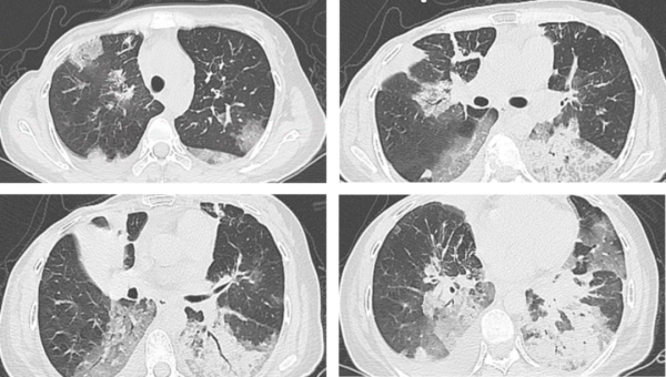 恒瑞行配资 当机械的呼吸唤醒冰封的双肺——重症医学科成功救治一例肺纤维化急性呼吸衰竭患者