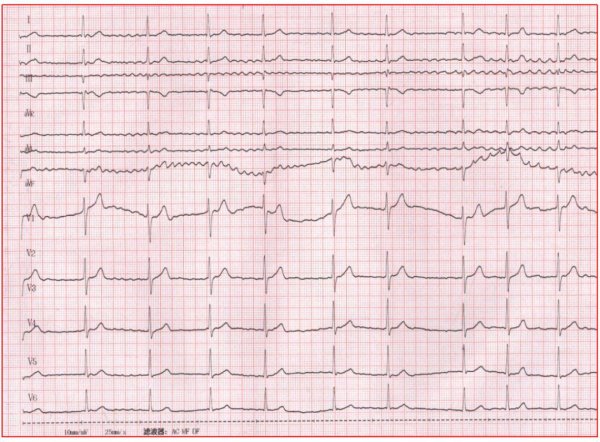 永华证券 吃了2个鸡蛋2杯水，竟引发6次室颤……